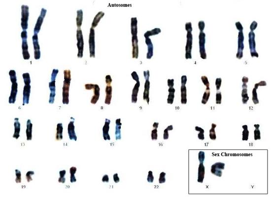 Karyotype Pictures Of Spina Bifida 81